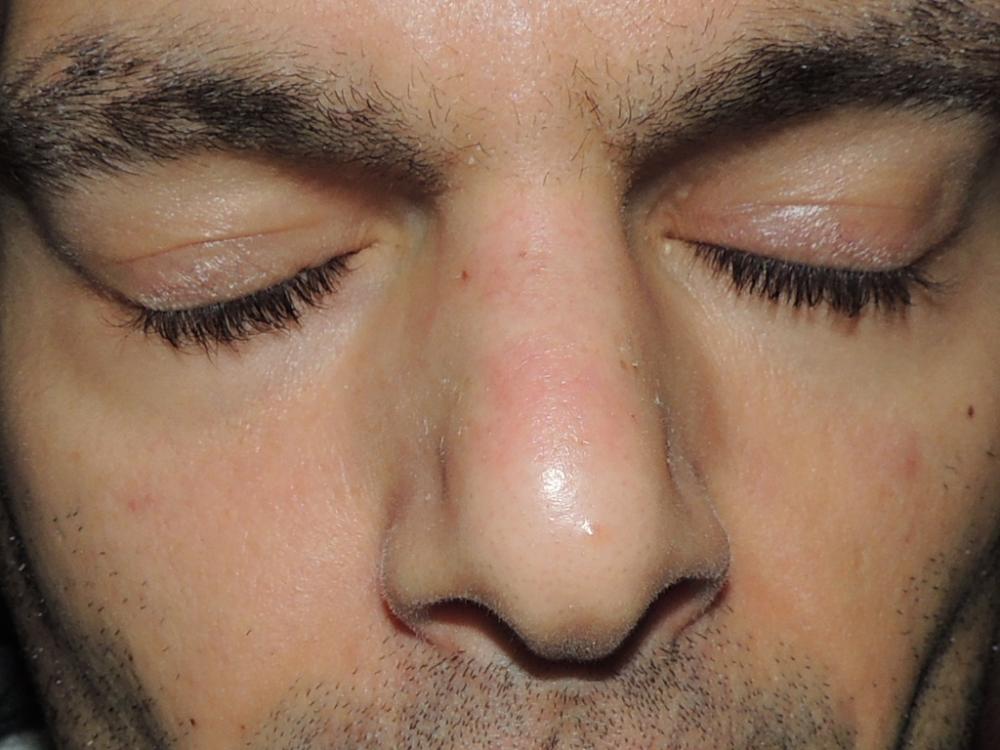 Red marks on nose and under eyes? - Hyperpigmentation - red/dark marks