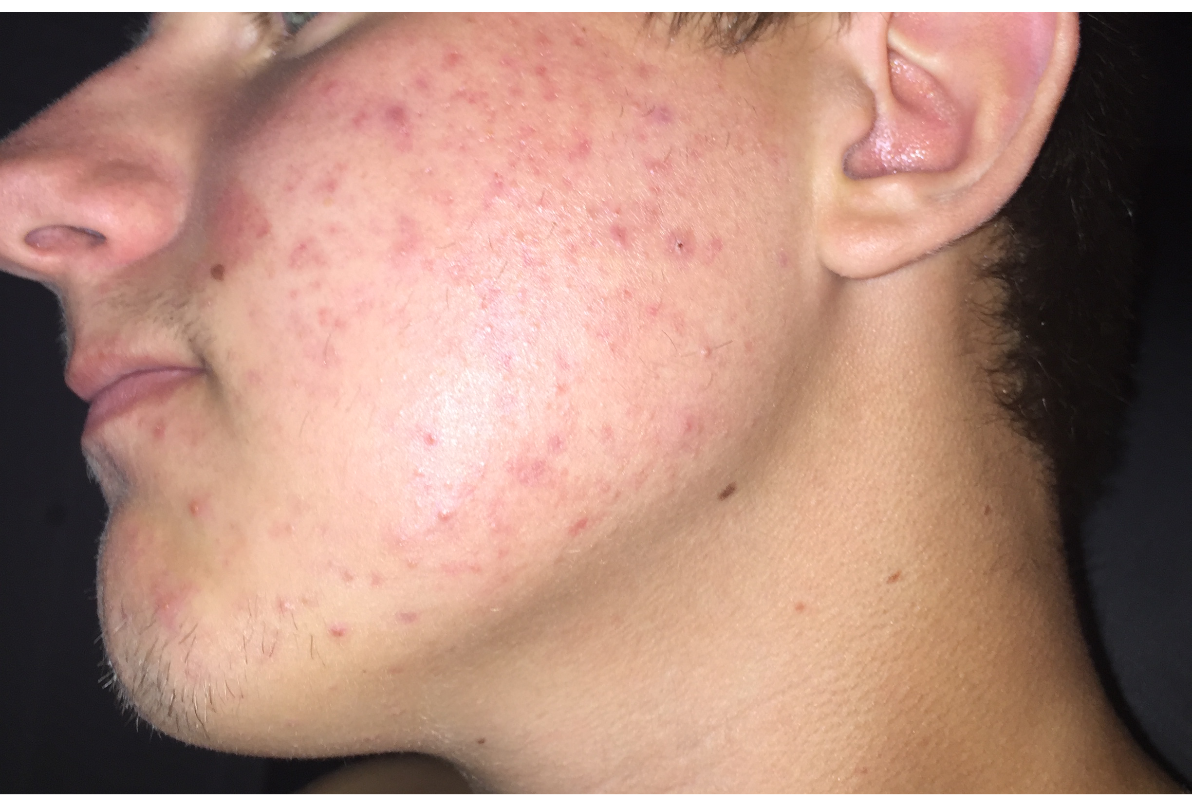 Pigmentation or Scars on cheeks need some advice - Scar treatments