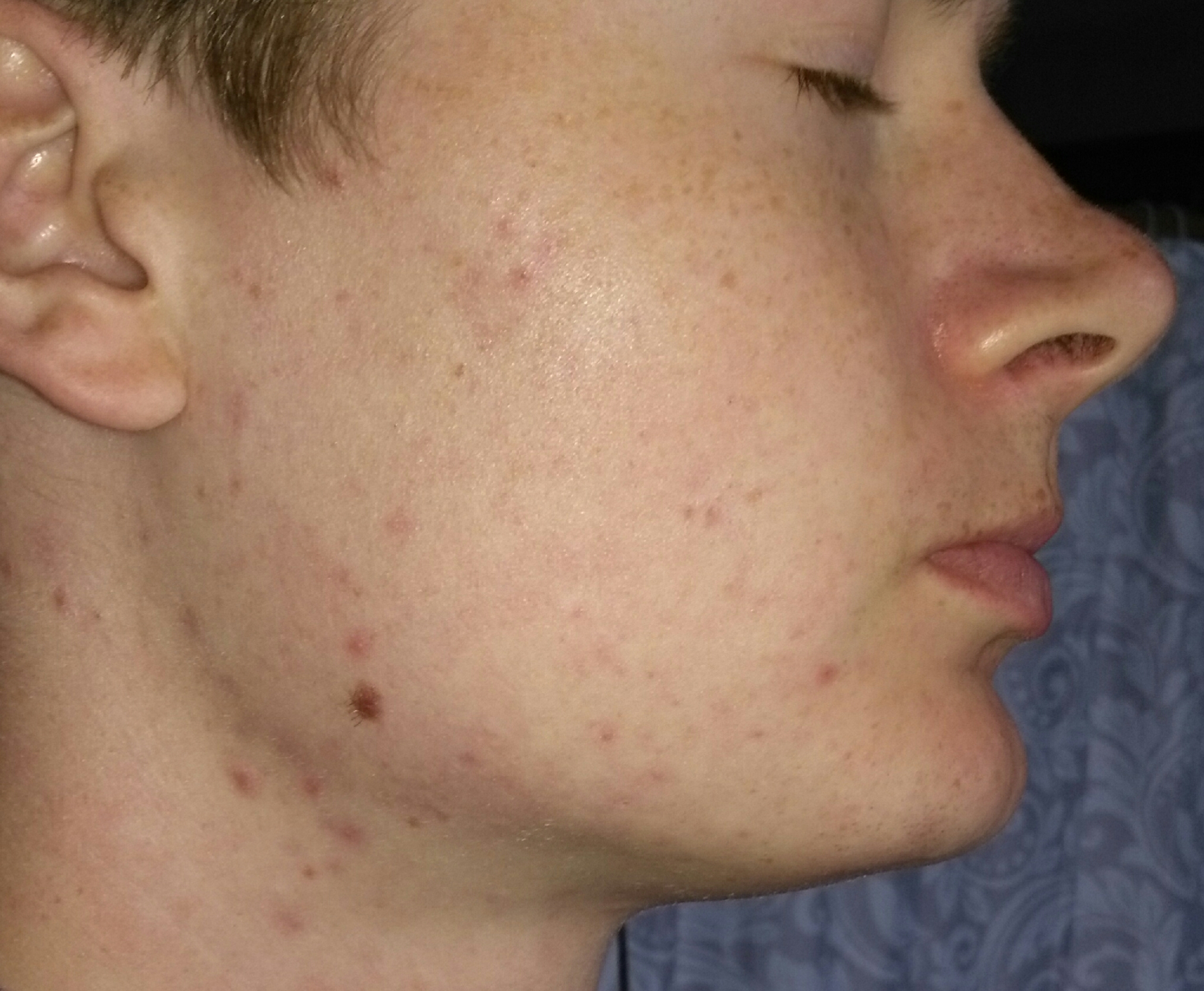 red-spots-just-wont-go-away-hyperpigmentation-red-dark-marks-by