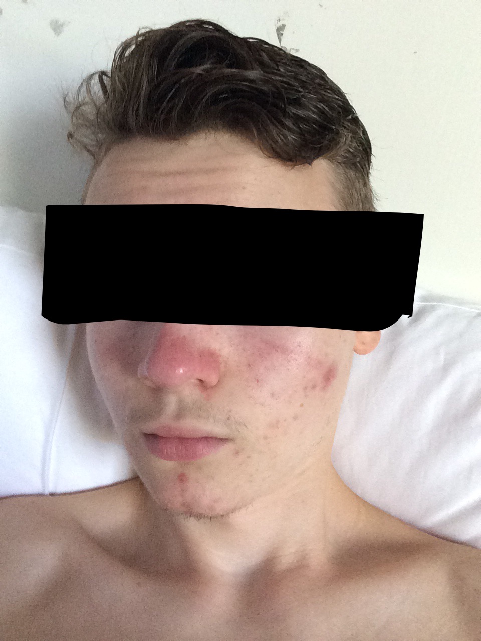 Red Face Nose After Shower Rosacea By Jakobs Rosacea And Facial