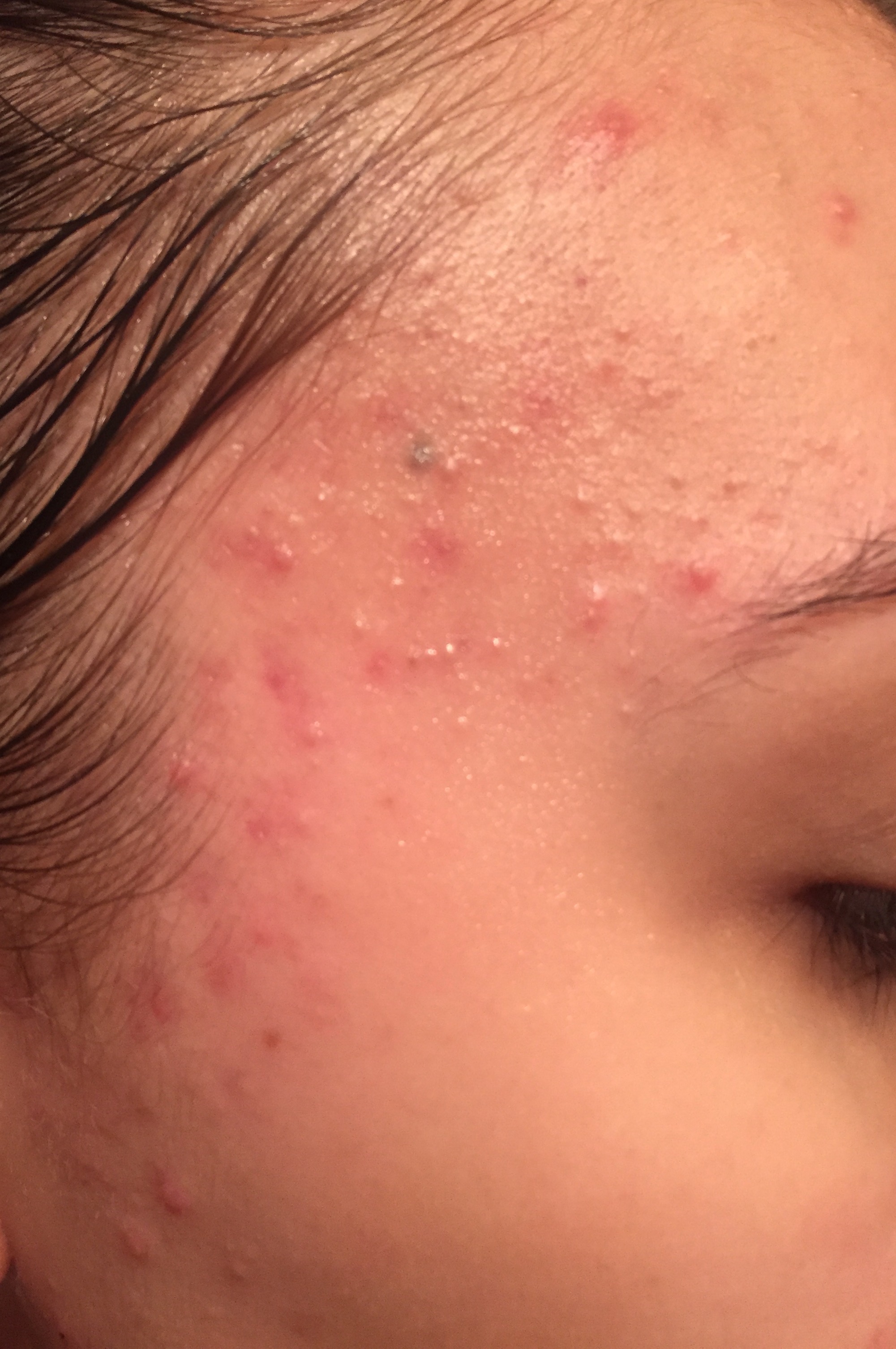 Weird acne all over face? - General acne discussion - by anjehlah1
