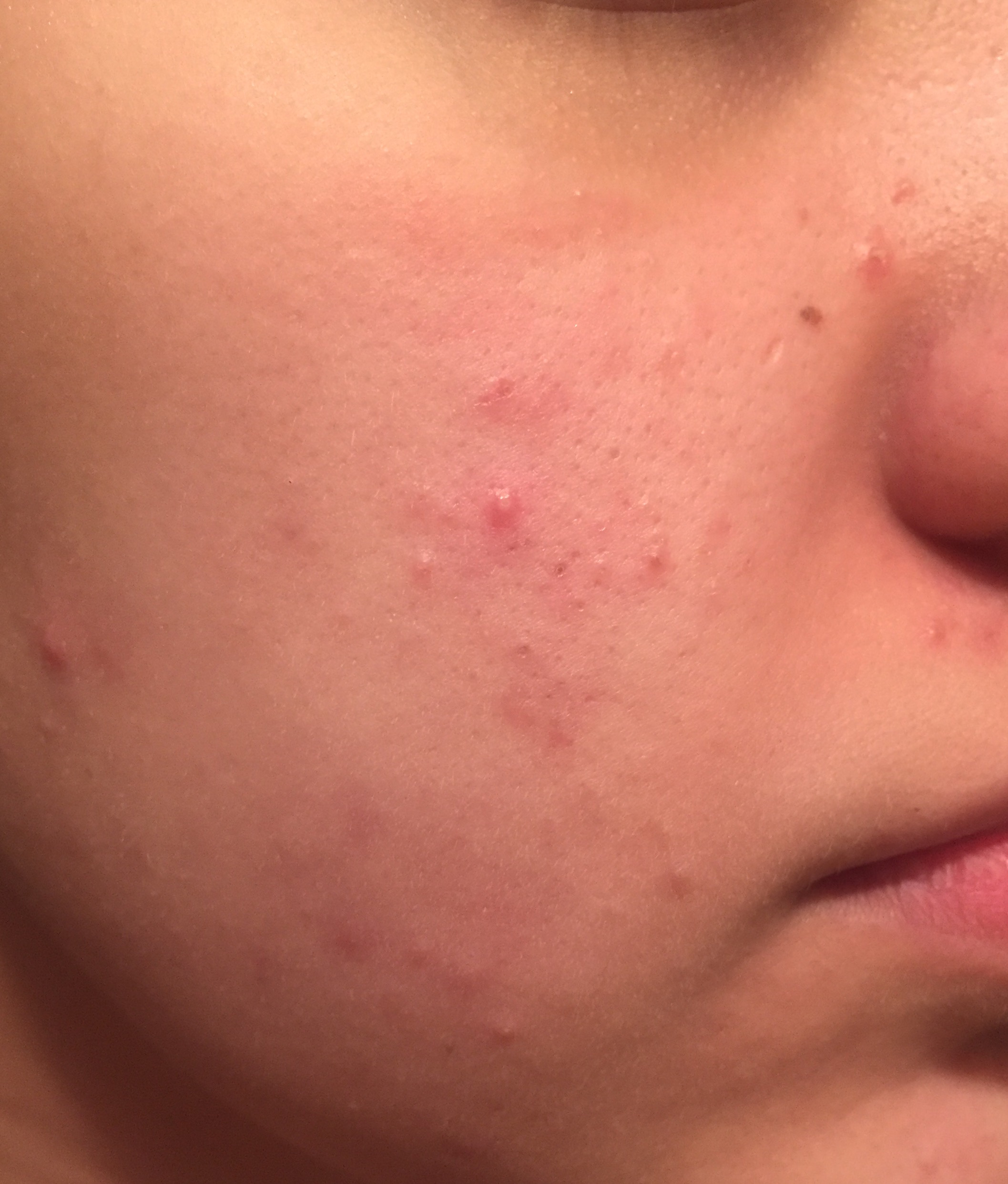 weird-acne-all-over-face-general-acne-discussion-acne