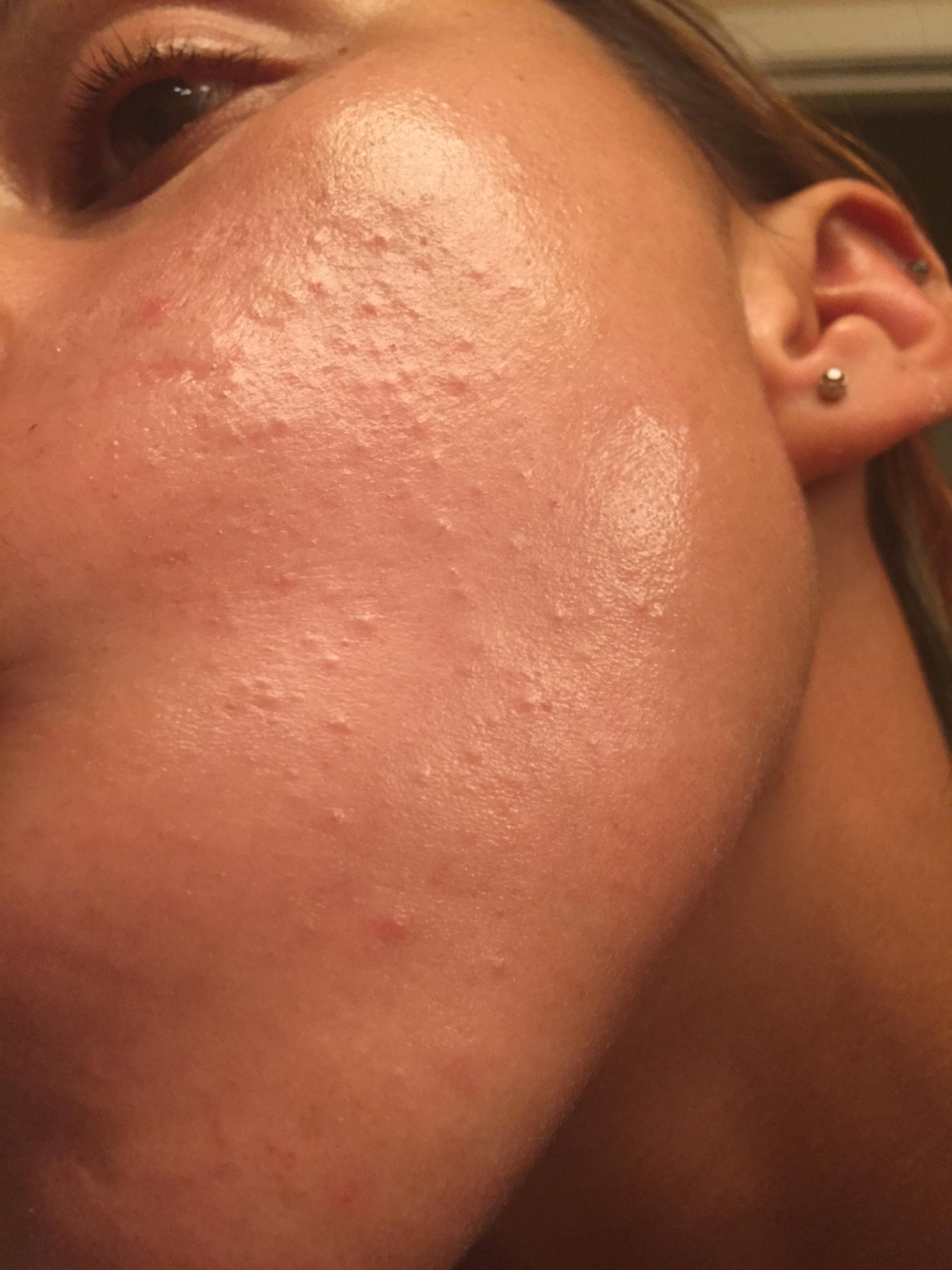 Comedonal Acne – What Is It And How To Treat It photo picture Comedonal Acne – What Is It And How To Treat It