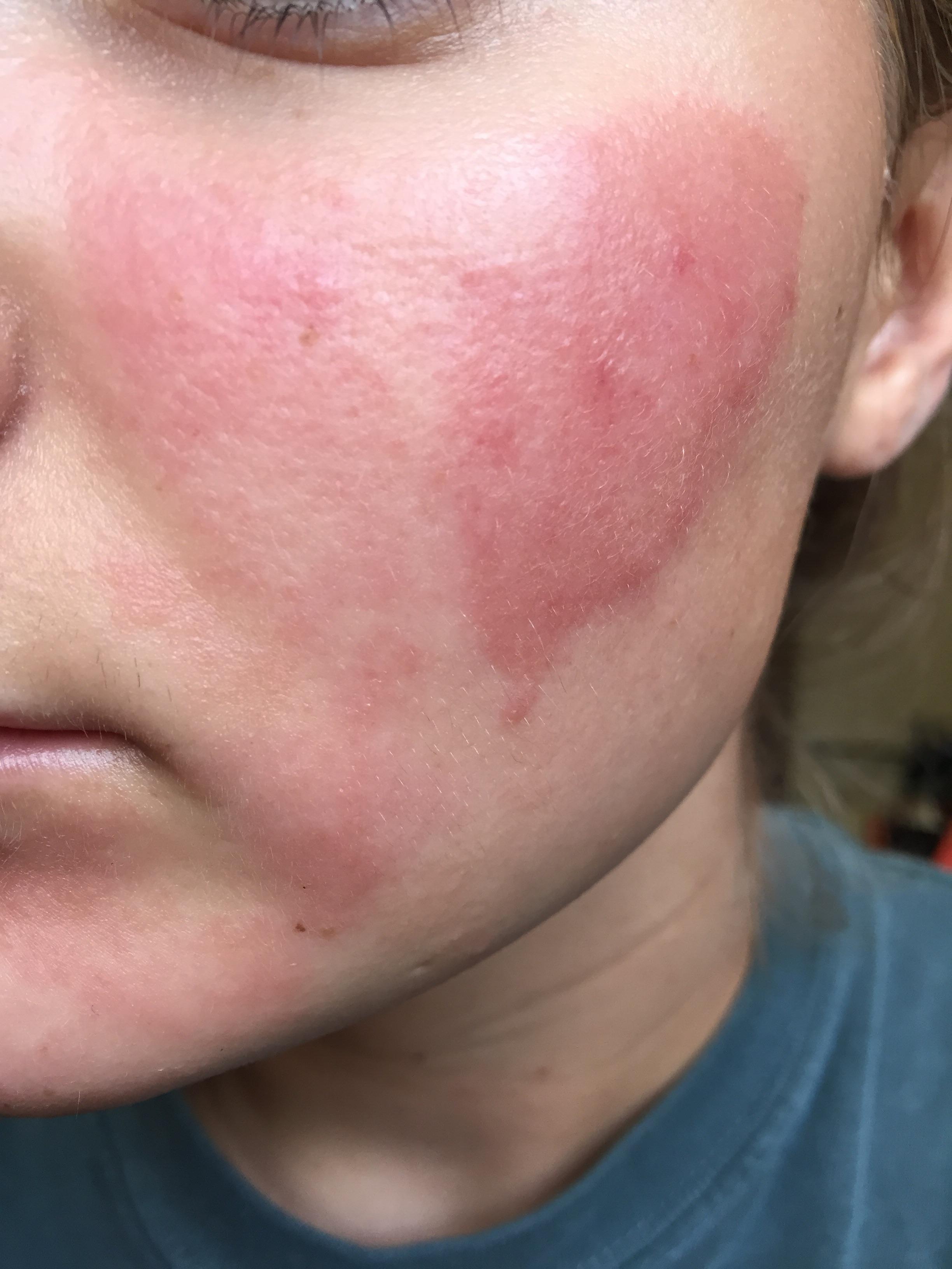 red-skin-rash-on-face