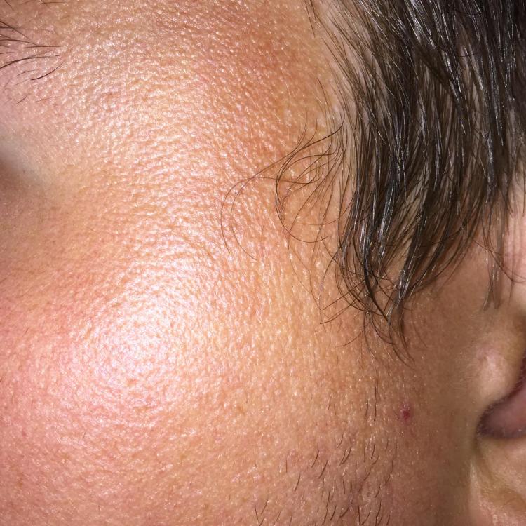 Accutan – Horrible texture after! Help! Pics – Prescription acne ...