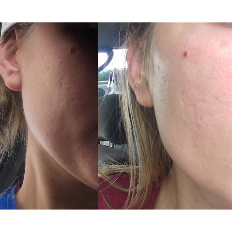 do-acne-scars-ever-really-go-away