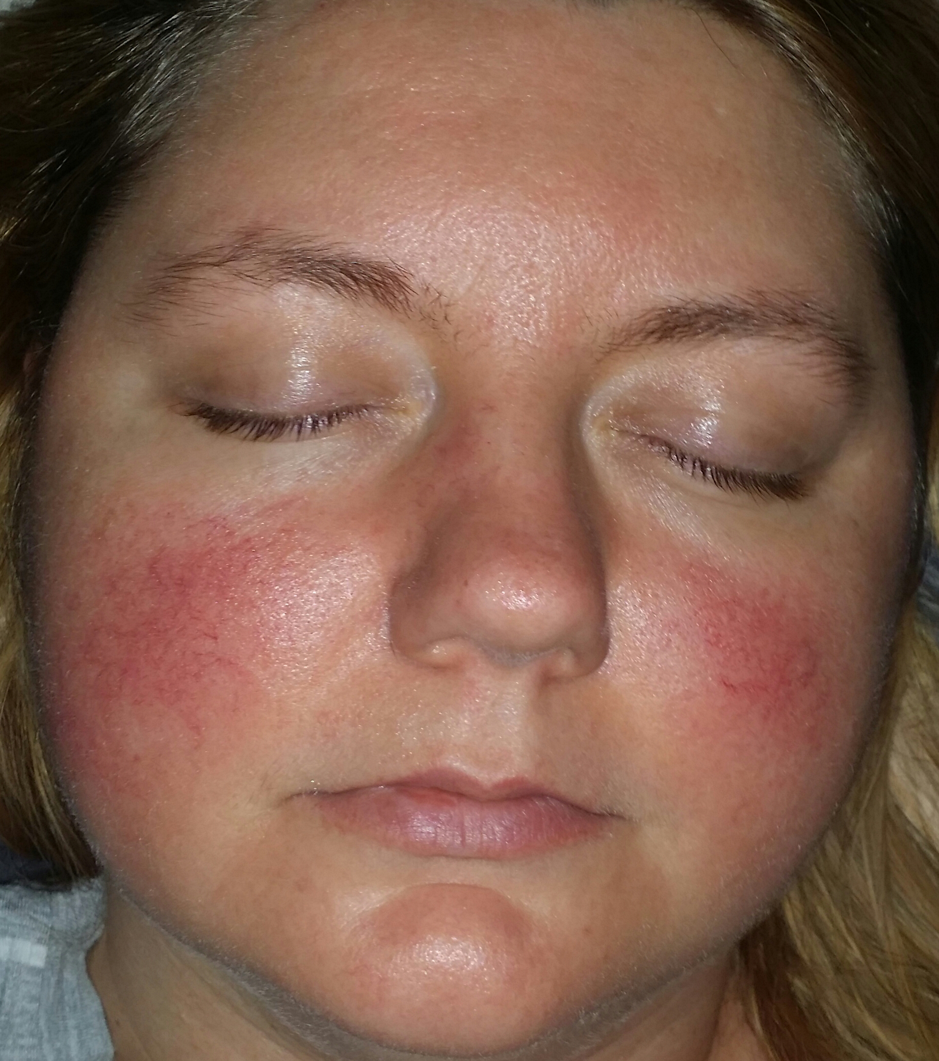 Is it rosacea? - Rosacea & facial redness - by trishmariep - Acne.org