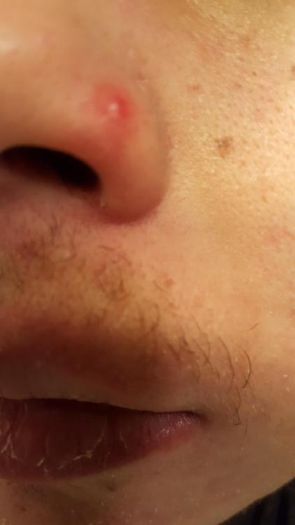 nose pimple.jpg