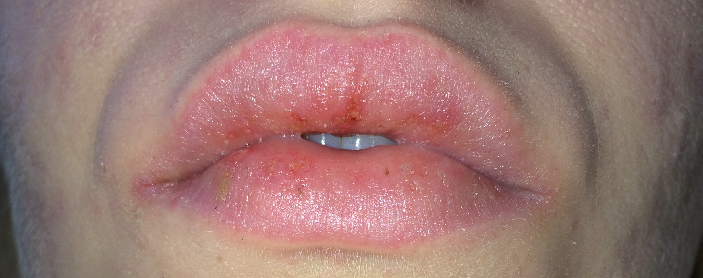 Need Help Worse Than Dry Lips Accutane Isotretinoin Logs By 