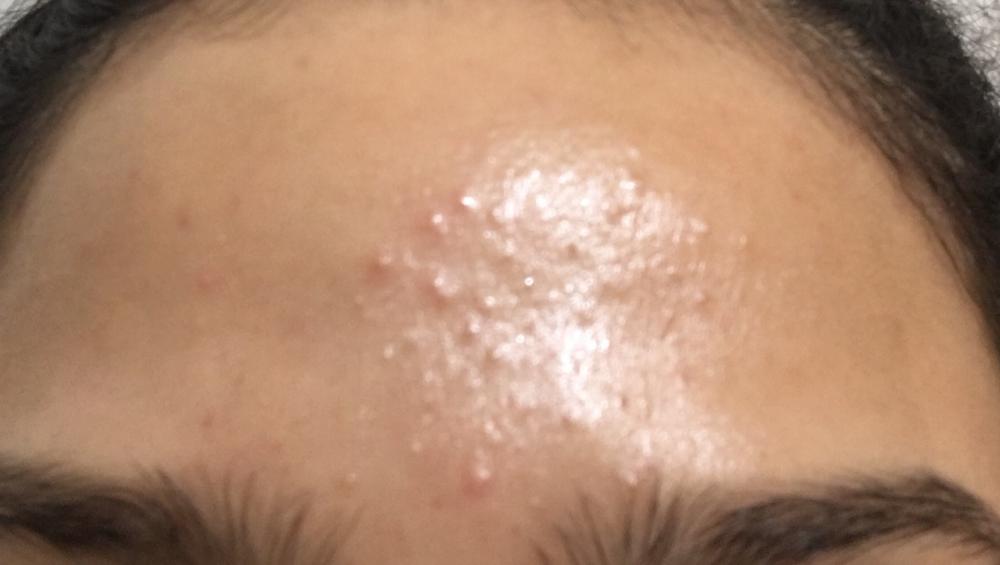 Small bumps over forehead? Read more - General acne ...
