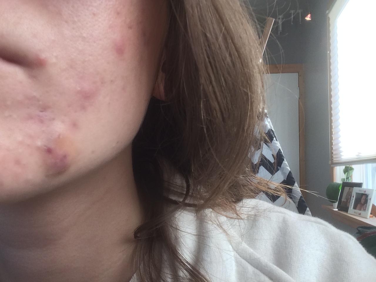 HELP! Under the skin blood bubble on chin – General acne discussion ...