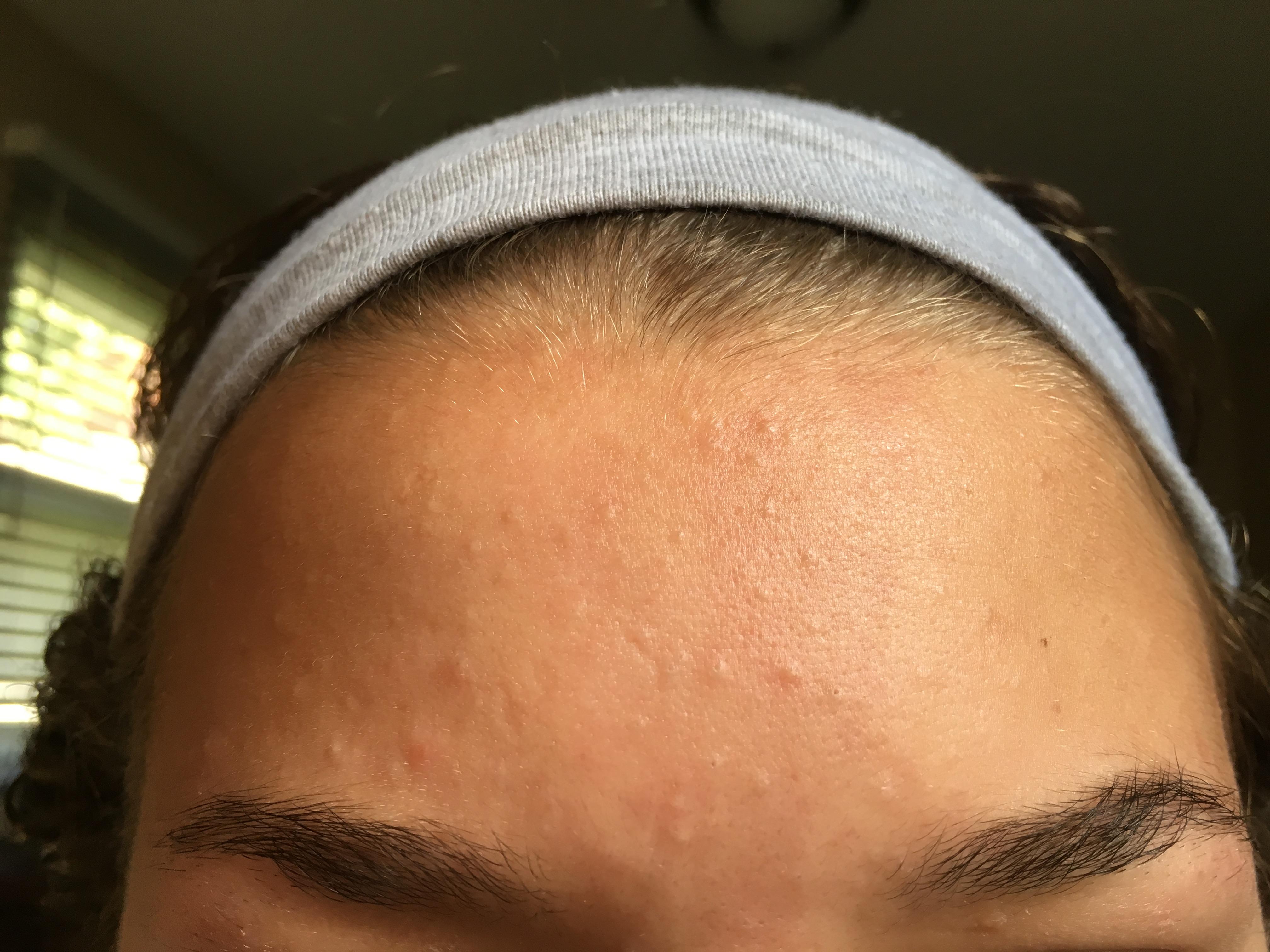 How To Get Rid Of Small Forehead Bumps Change Comin