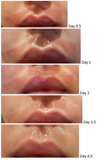 waxing wait before after how accutane to long