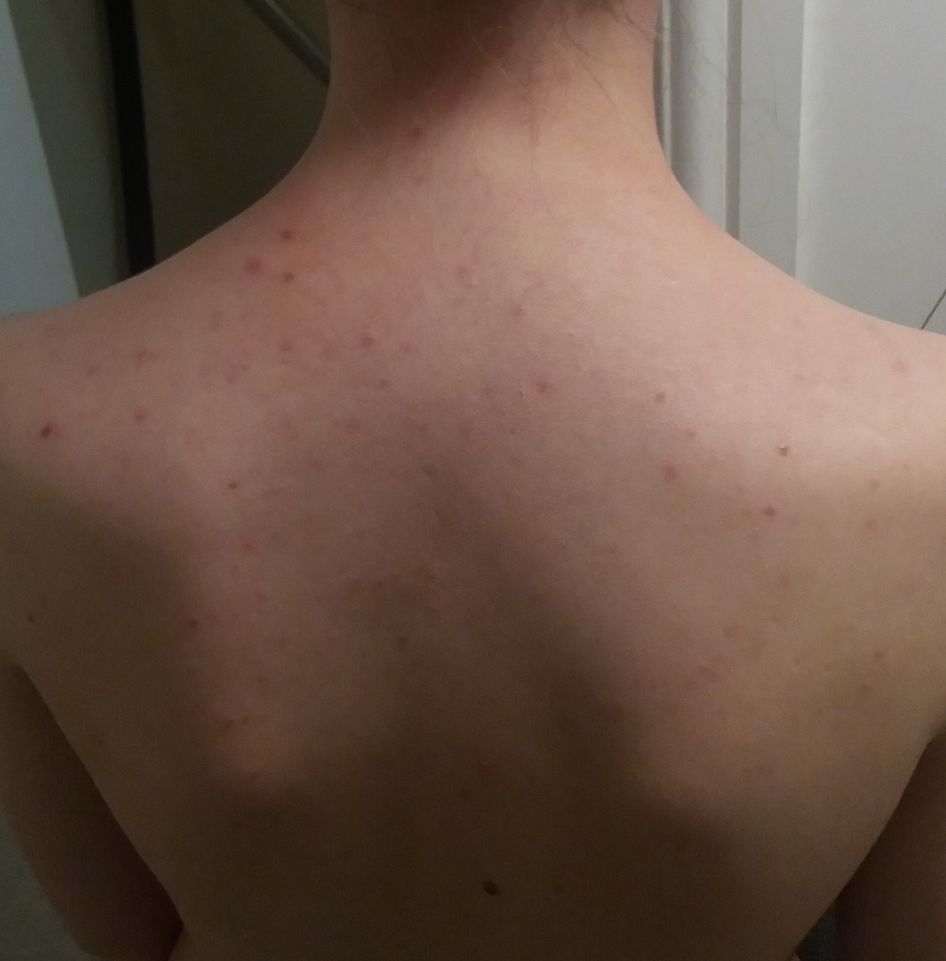 Red Bumps On My Back General Acne Discussion Acne Forum