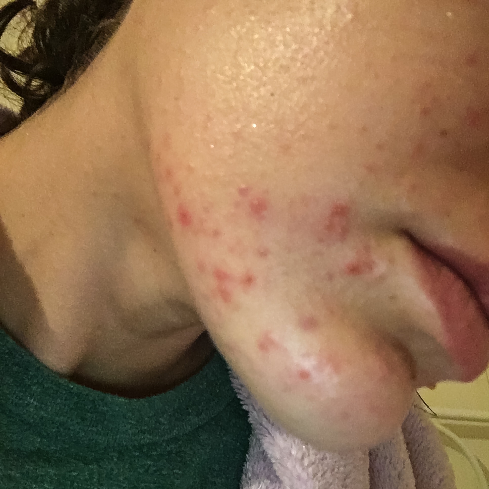 Took 2 Plan B pills in one week… HELP?! – Hormonal acne – Acne.org 