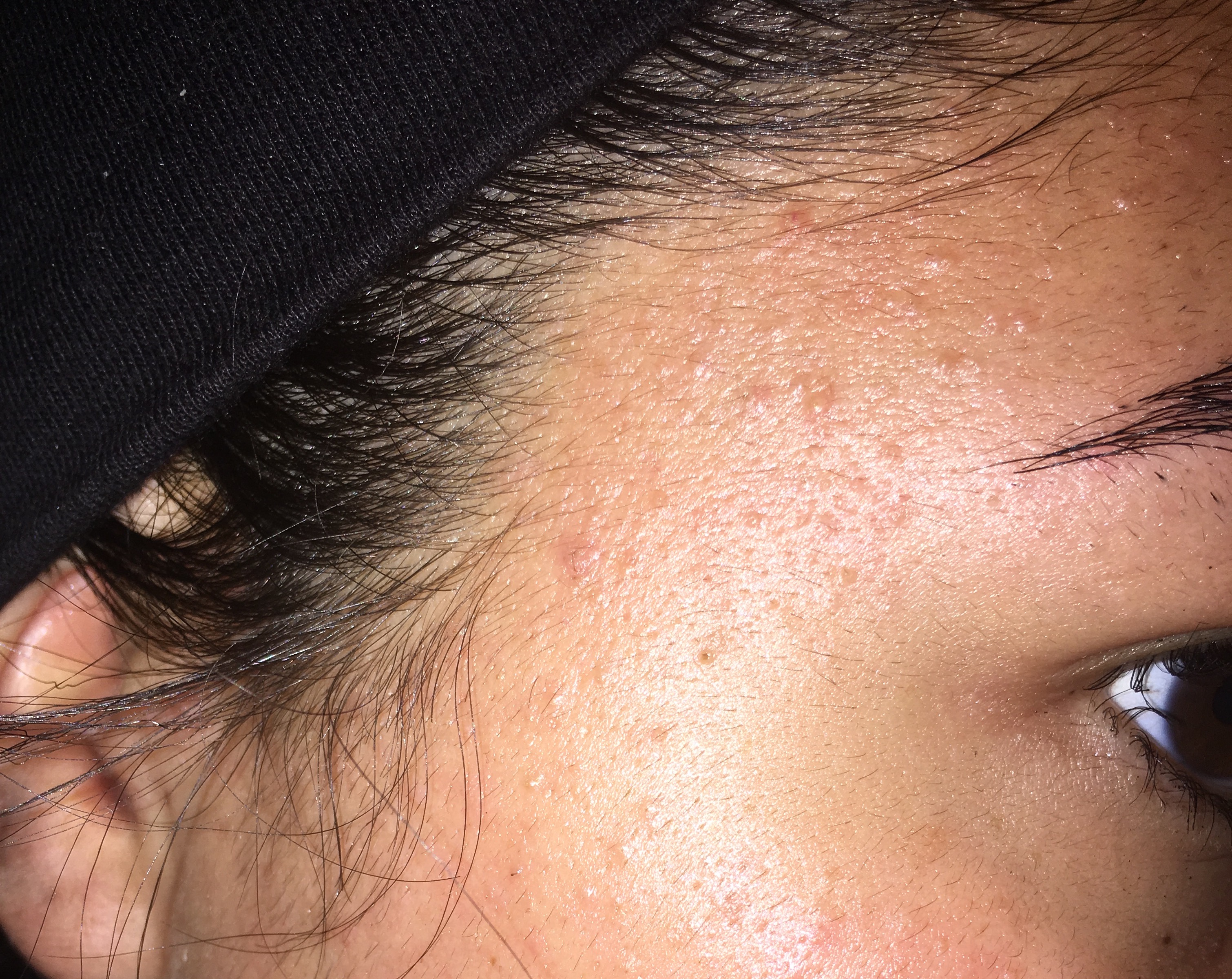 is this acne or Pityrosporum Folliculitis? - General acne discussion