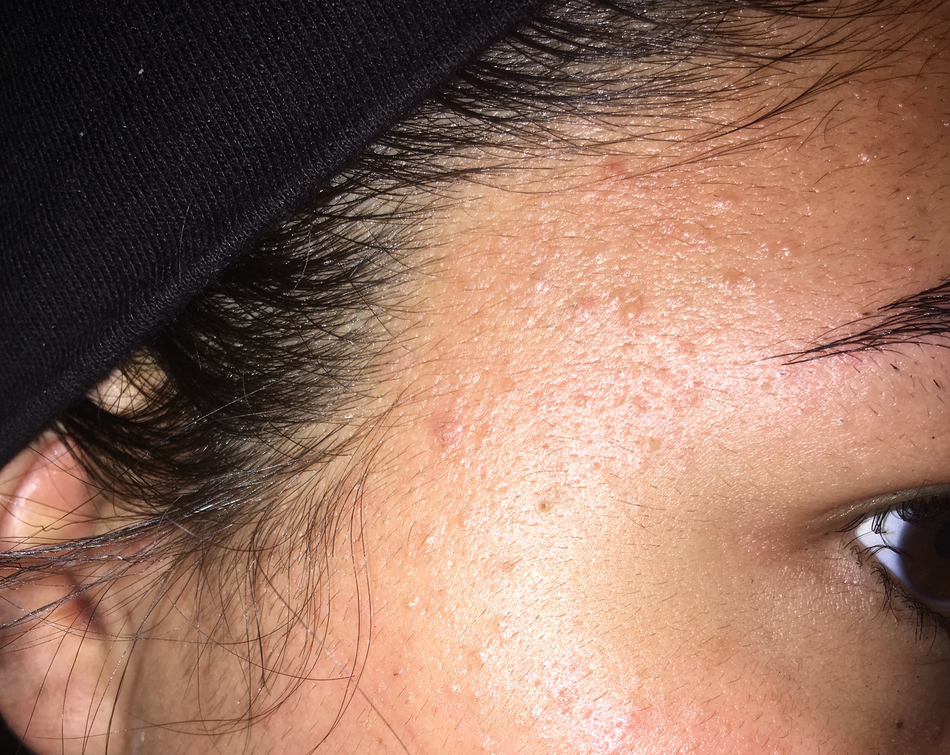 Folliculitis Forehead