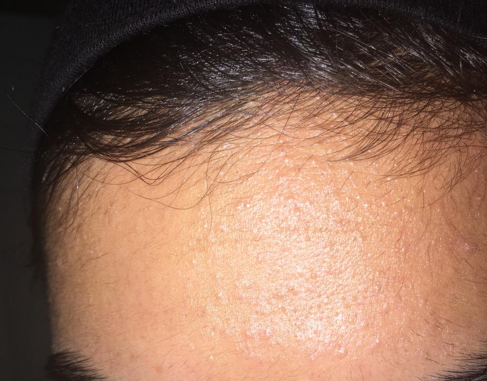 Acne scalp 