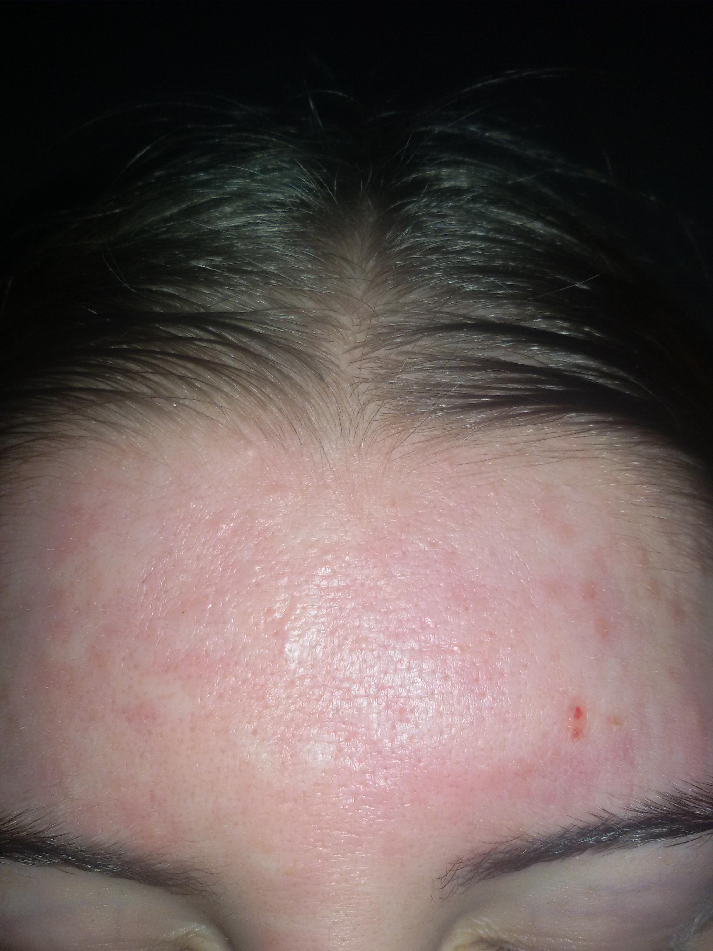 Blackheads And Scars On Forehead General Acne Discussion Acne Org Forum