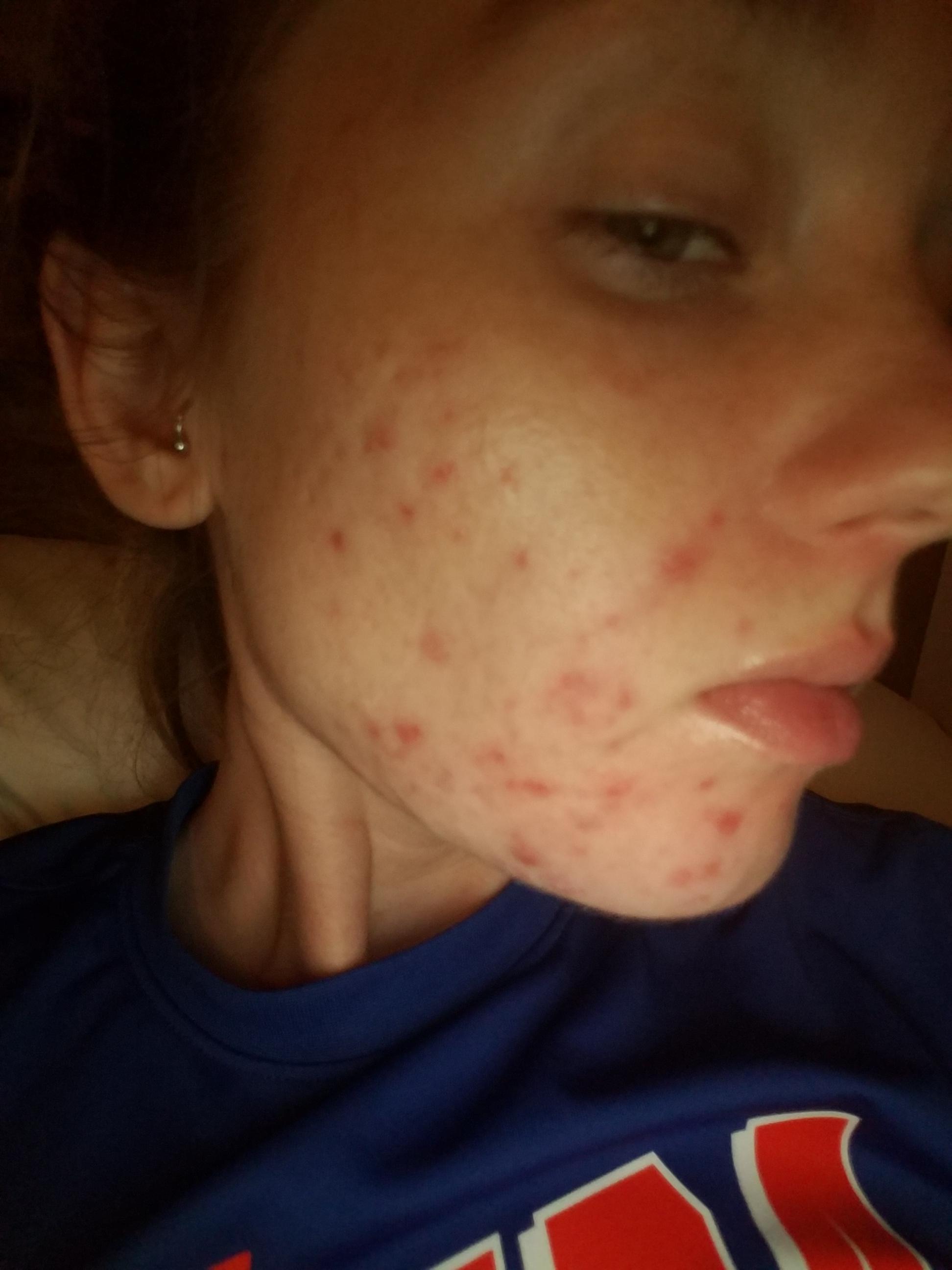 Accutane log with pictures day 6 - Personal logs - Acne Accutane log with pictures day 6 - Personal logs - Acne