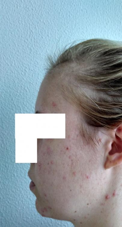 acne 1.jpg