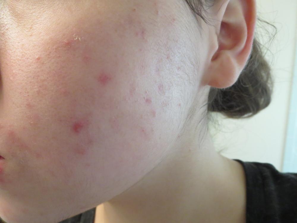 acne 001.JPG