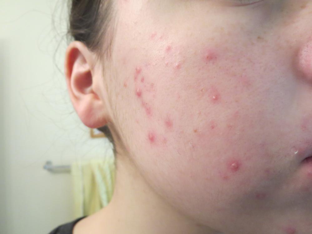 acne 002.JPG