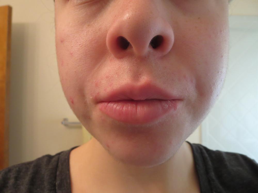 acne 004.JPG