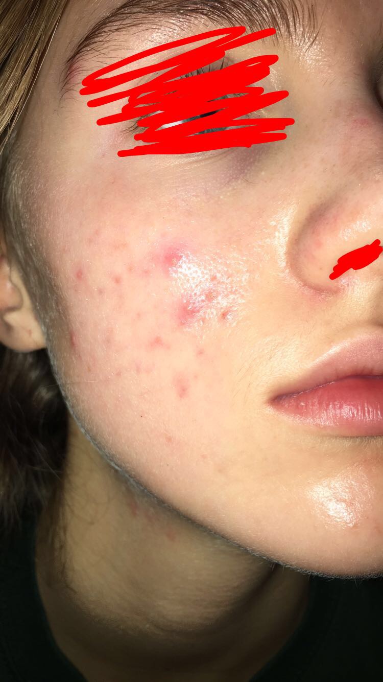 think accutane working i dont is