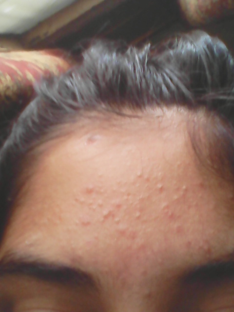 Small red forehead bumps! PLEASE HELP! - General acne discussion - Acne ...