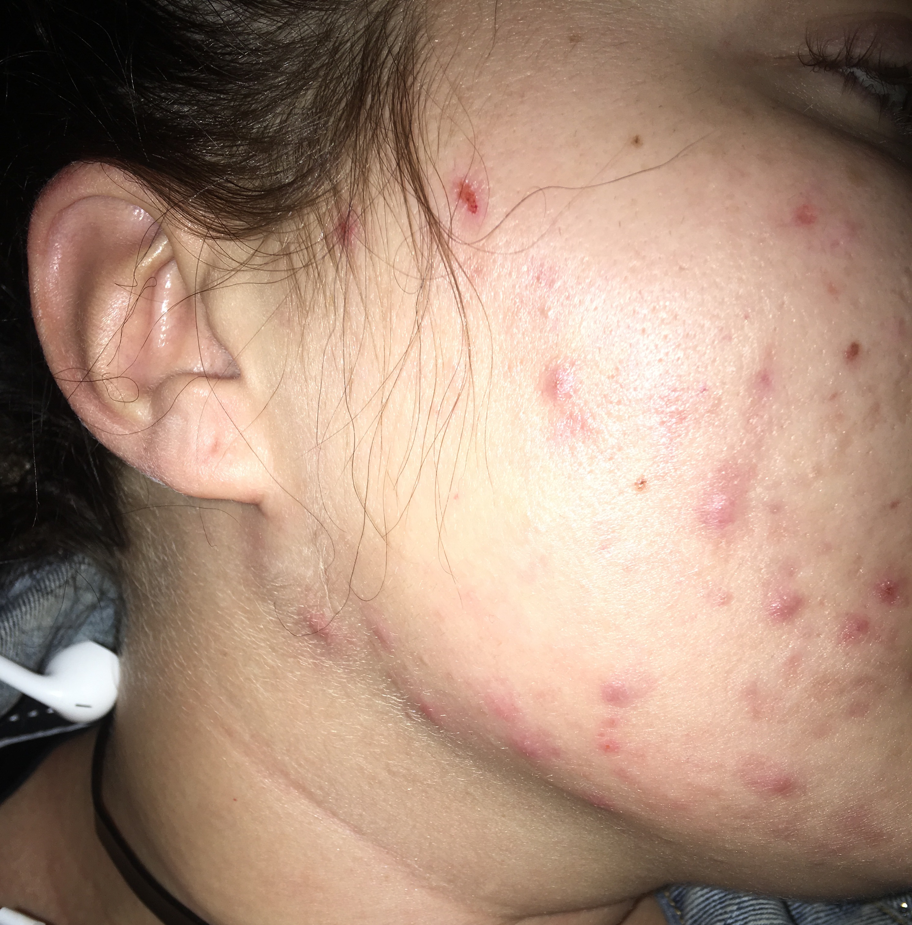 Hard, Itchy, Painful Bumps Around Jawline - General acne ...