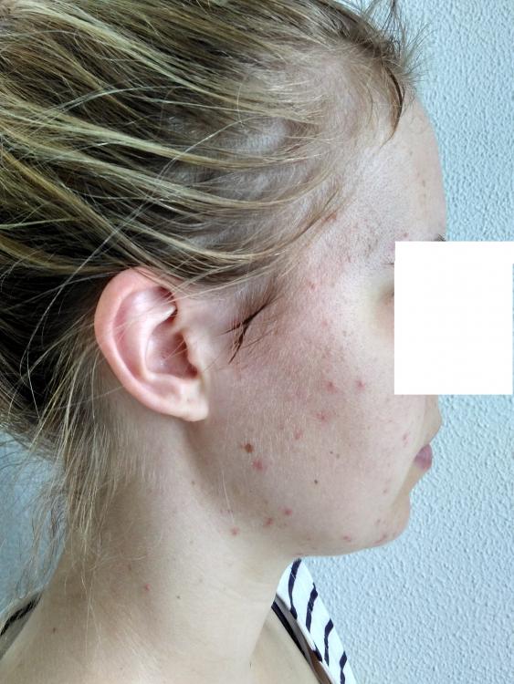 acne3.jpg