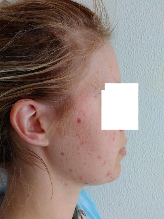 acne4.jpg