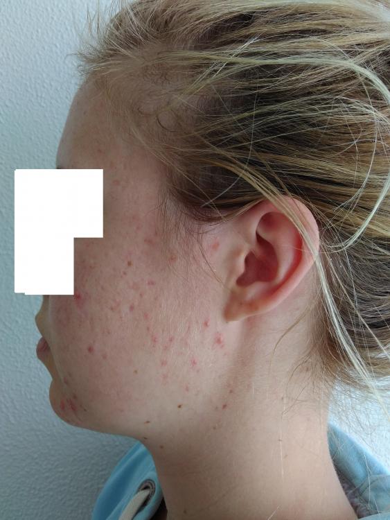acne5.jpg