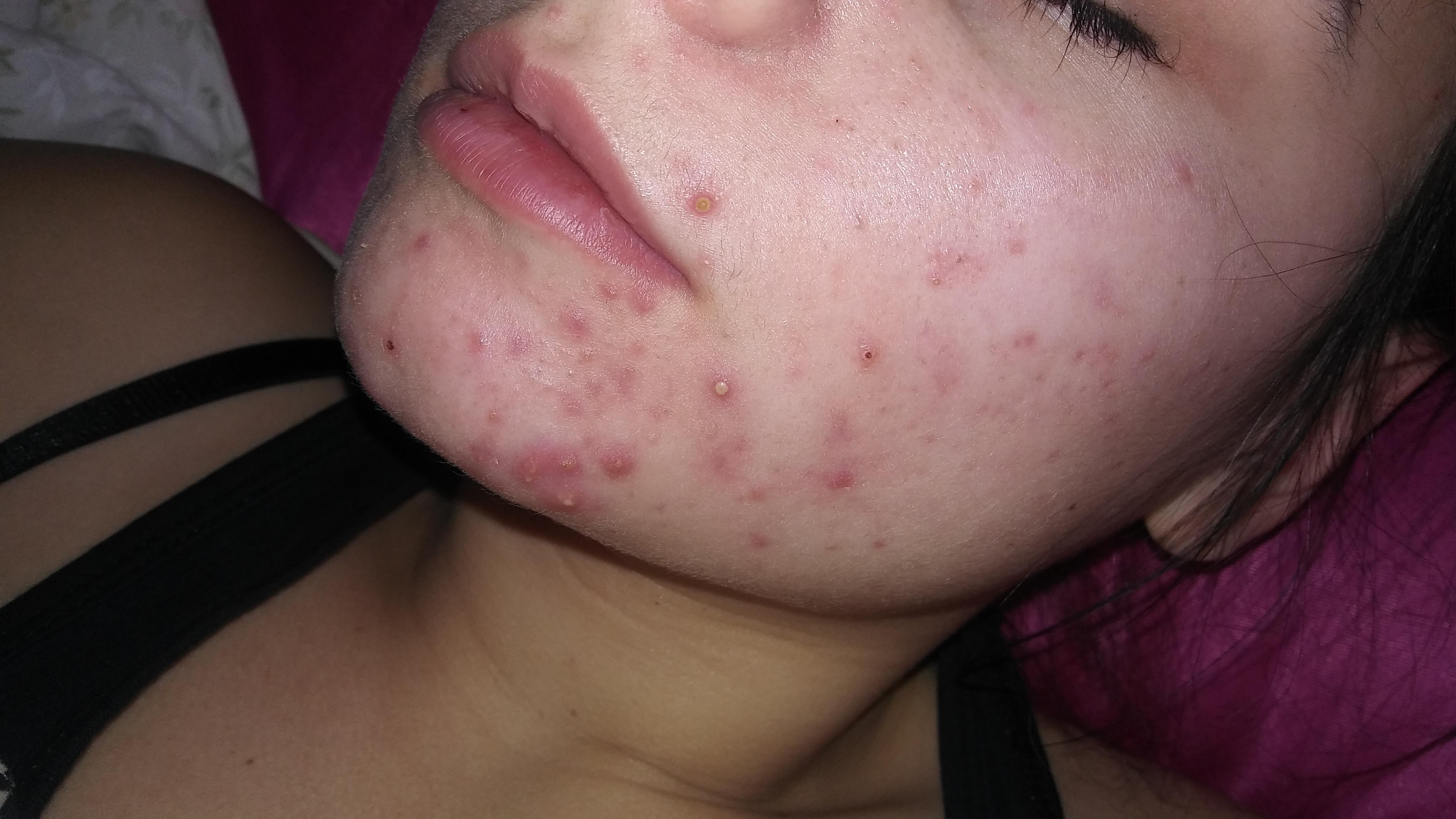 16 year old girl please help! - General acne discussion ...
