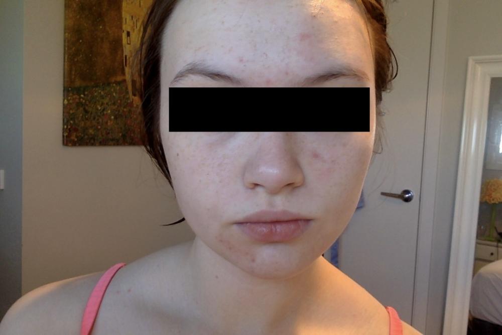 my skin 4 days ago.jpg