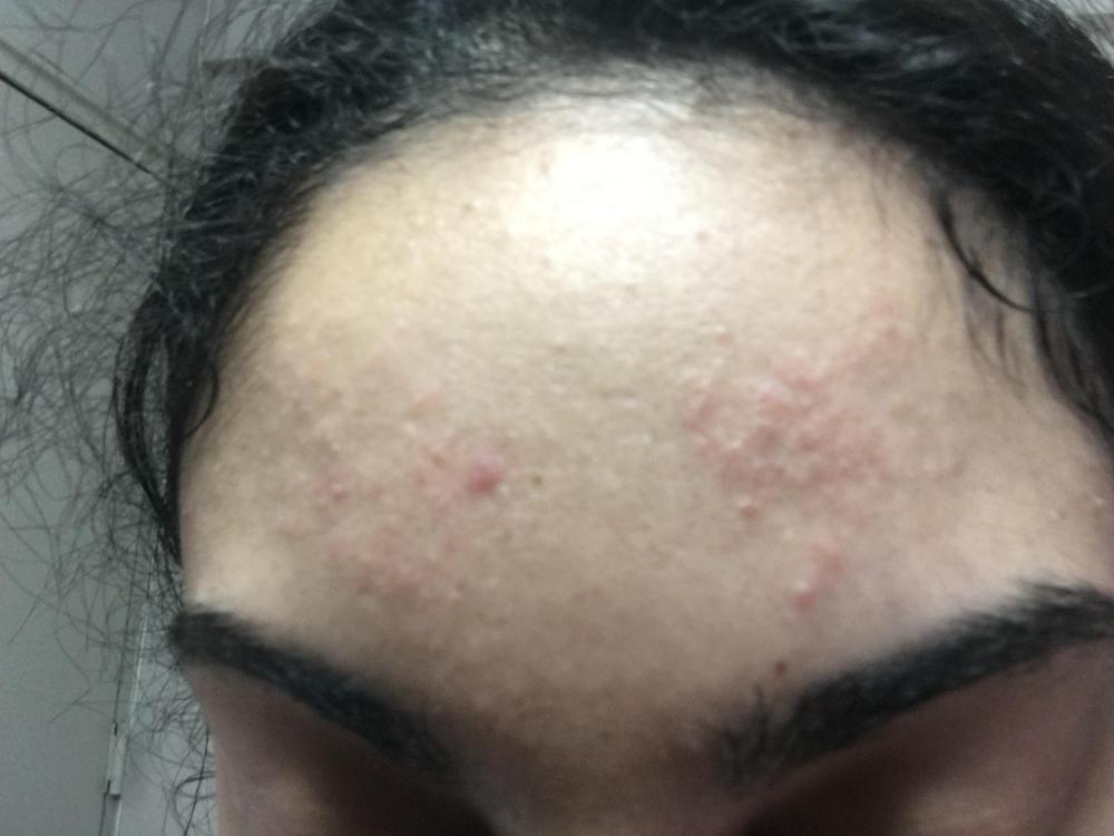 Forehead Rash Or Acne General Acne Discussion Forum