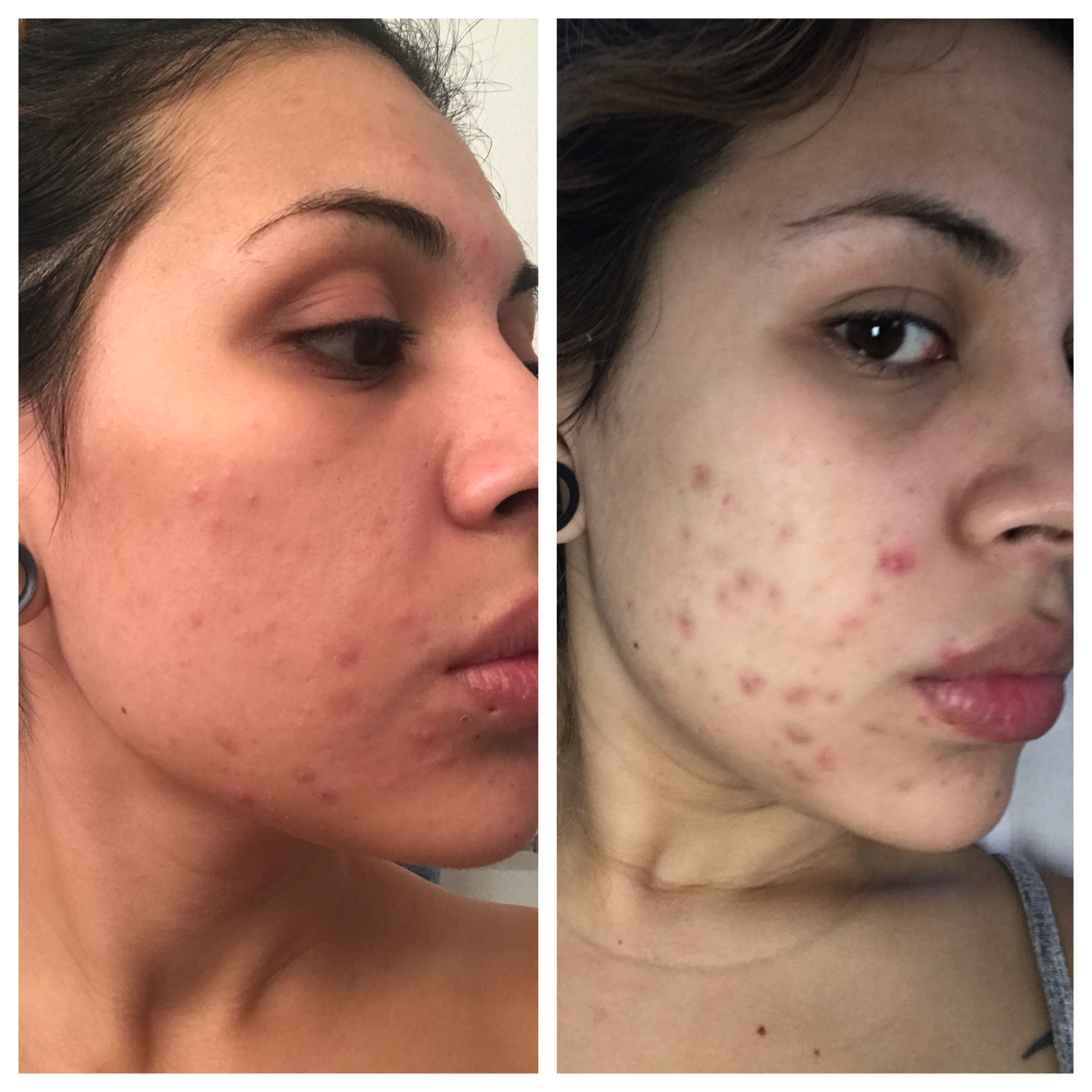 Skin Purge Before And After