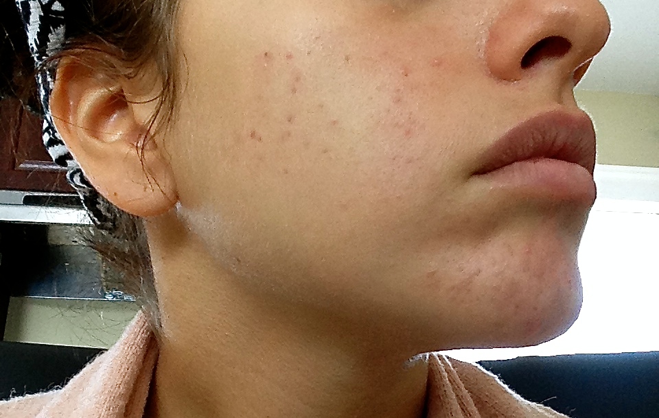 Losing Hope on Treating my Acne - General acne discussion - by