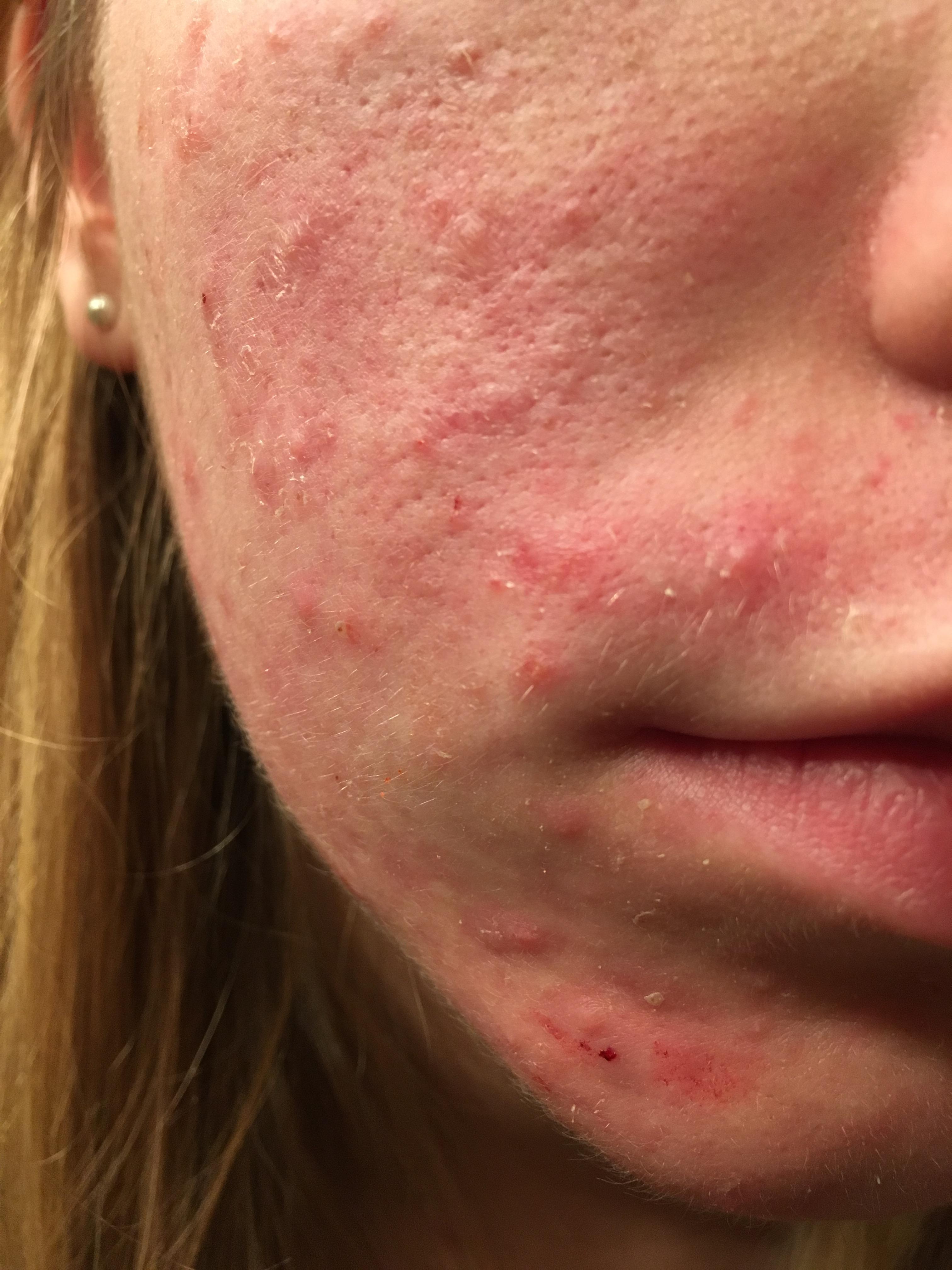 Extremely Dry Skin! Help! - General acne discussion - by