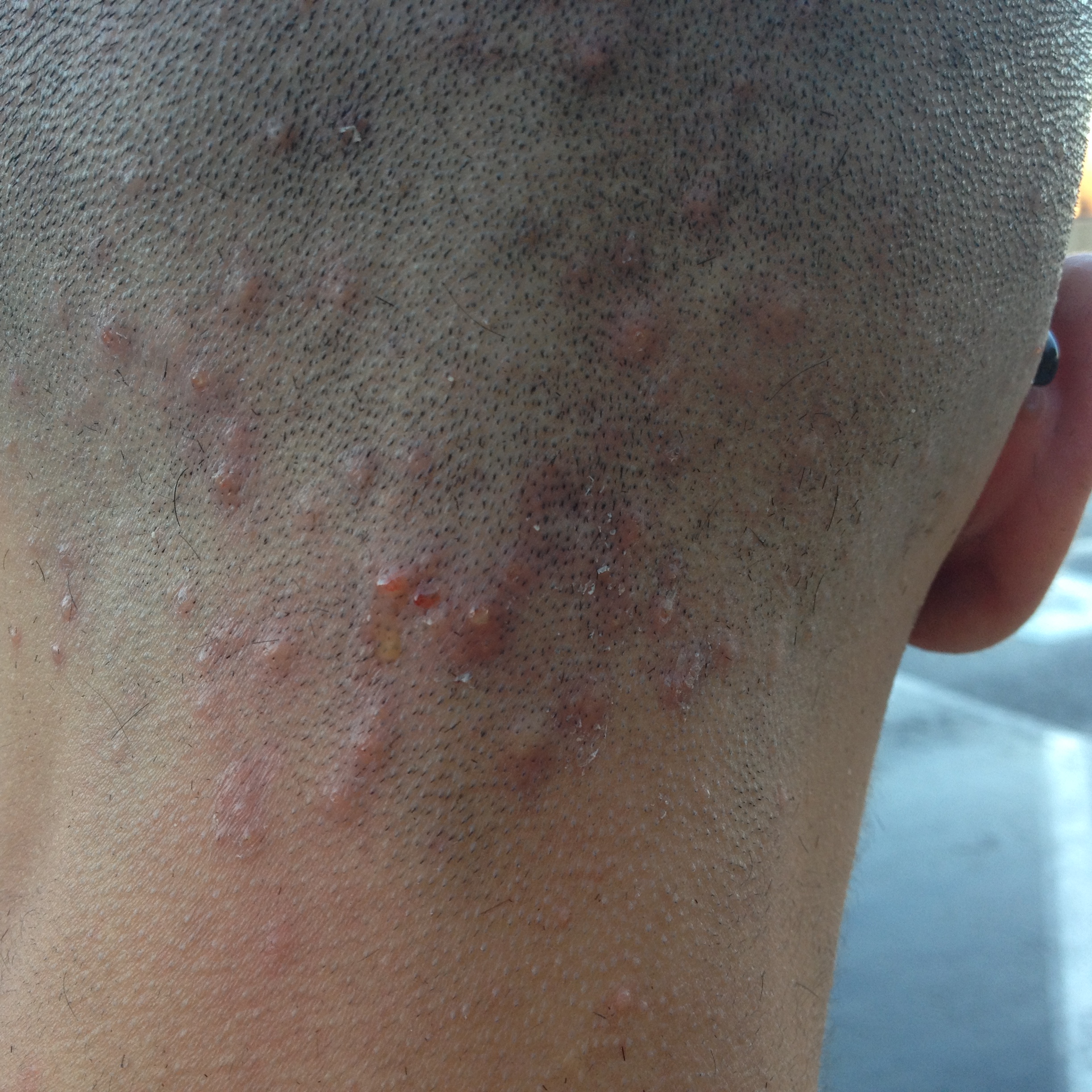 What Causes Pimples On The Back Of The Head