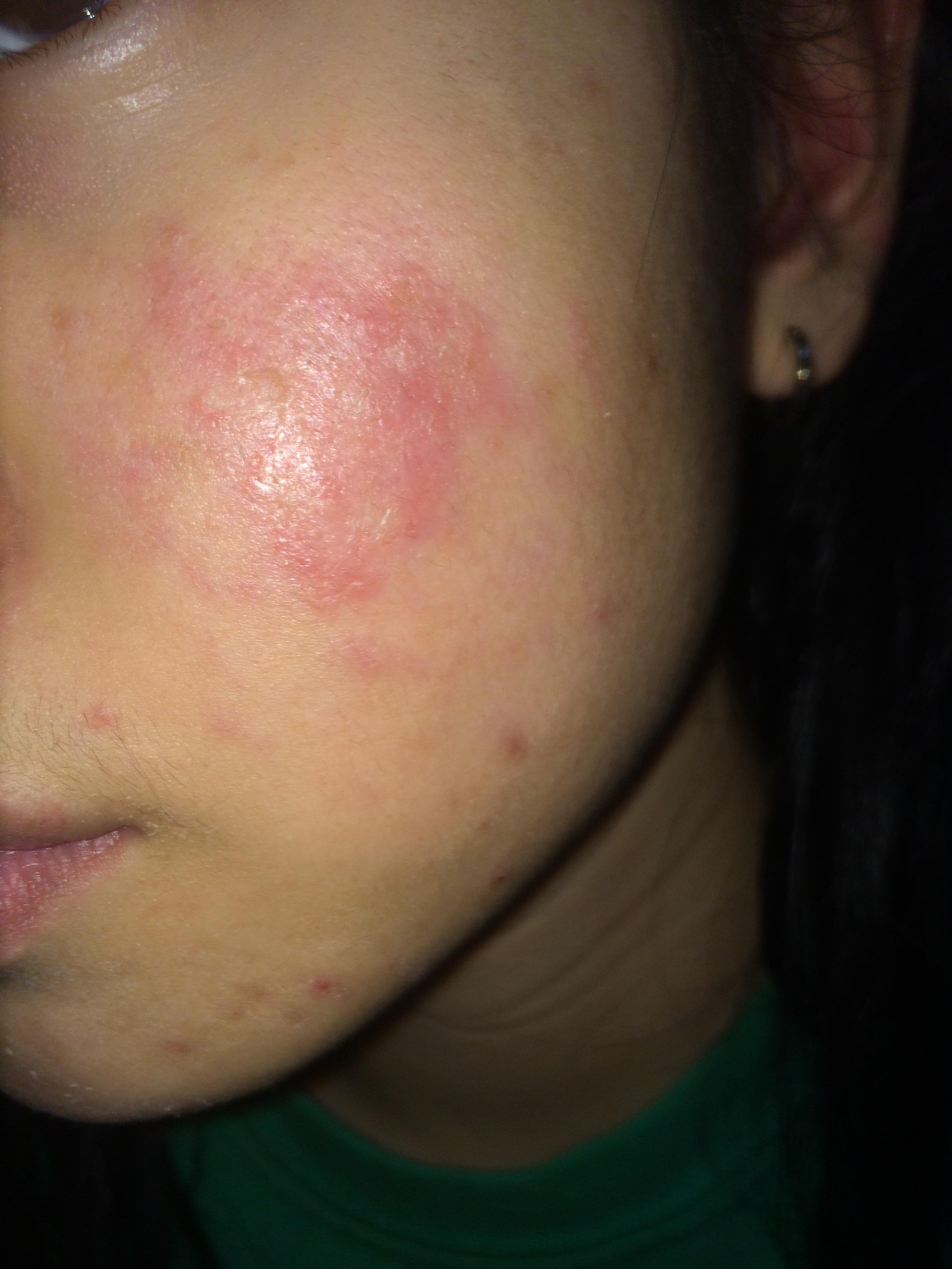 old scar itches like crazy Genertore2