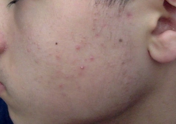 tiny-red-bumps-on-face-eating-disorder-support-forum