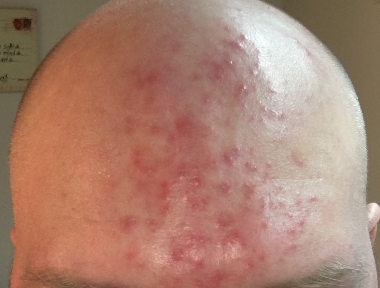 Acne On Forehead General Acne Discussion Forum 9932