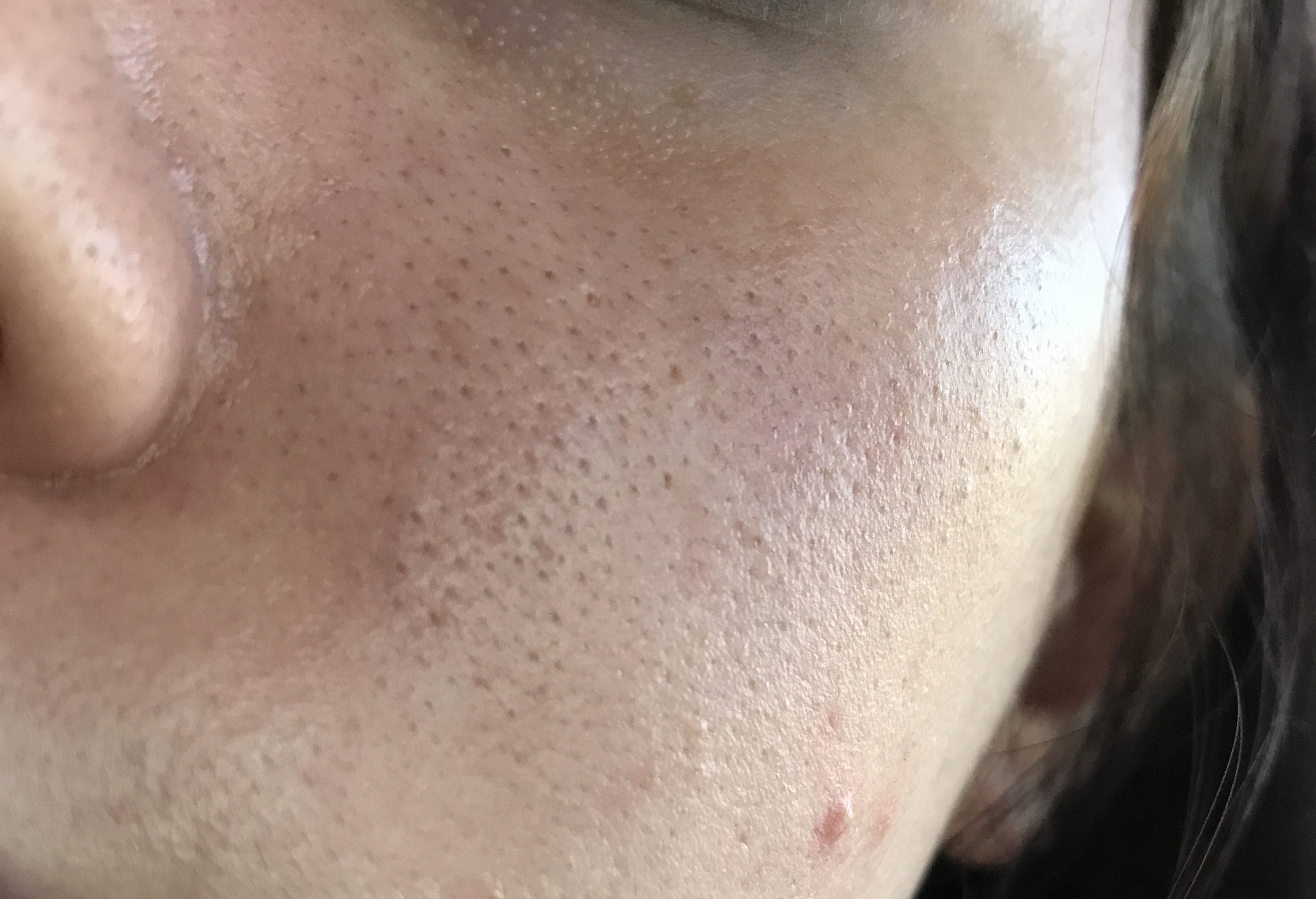 blotchy after red accutane skin