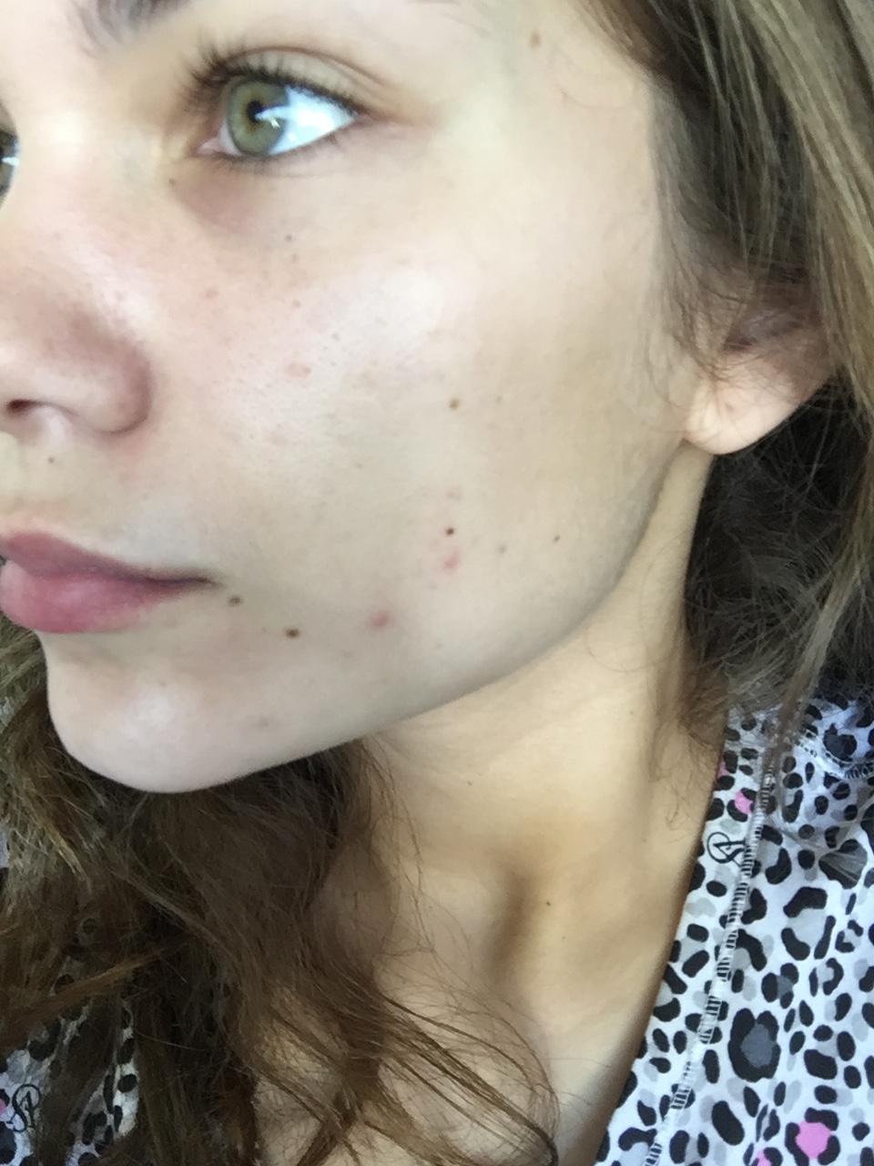 Red spots on face - Beauty Insider Community
