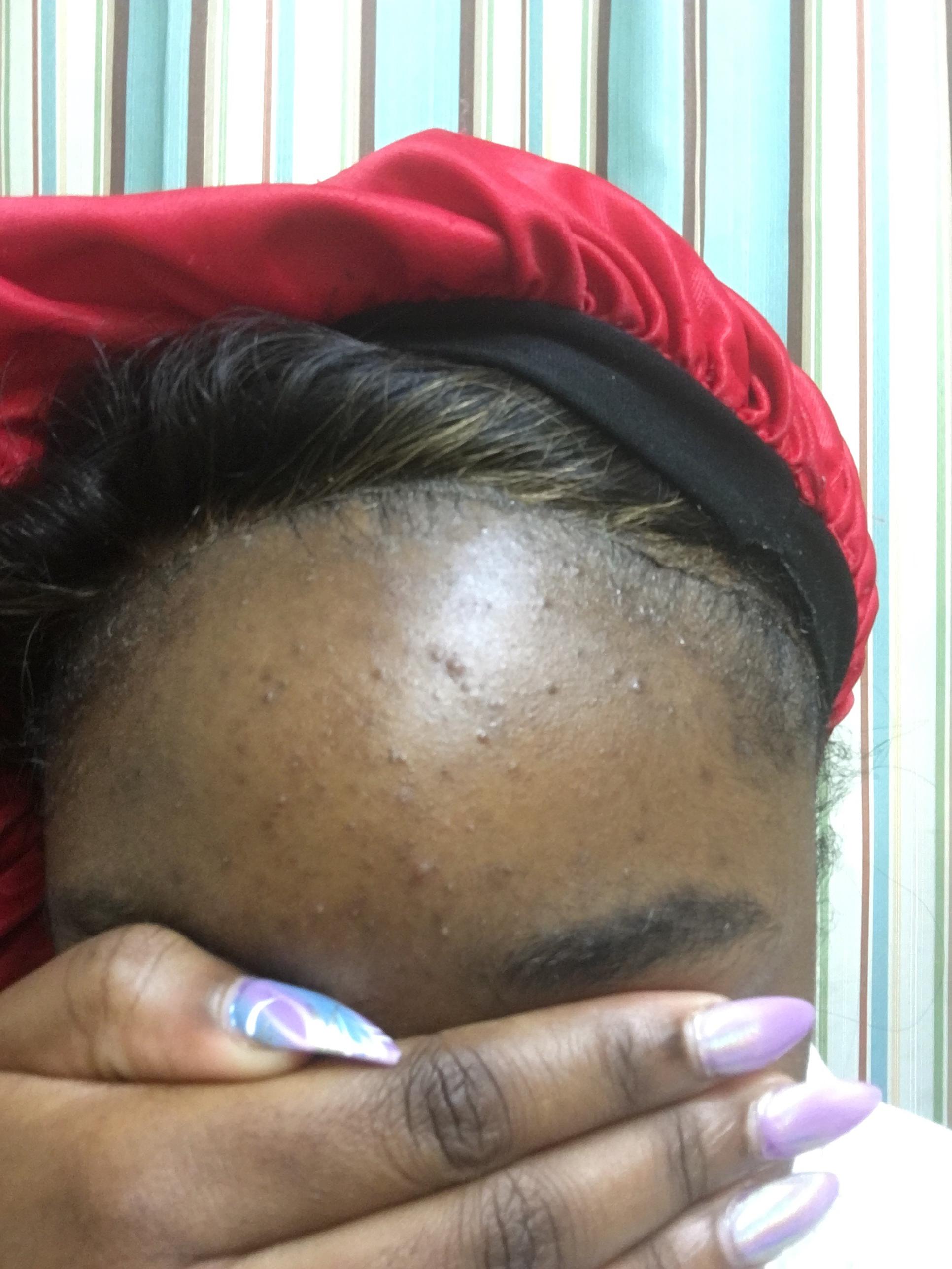 Why Do I Have These Fine Bumps On My Forehead And Hairline General Acne Discussion 9333