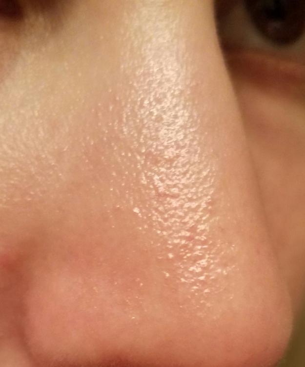 textured-bumps-on-my-nose-appeared-yesterday-general-acne-discussion