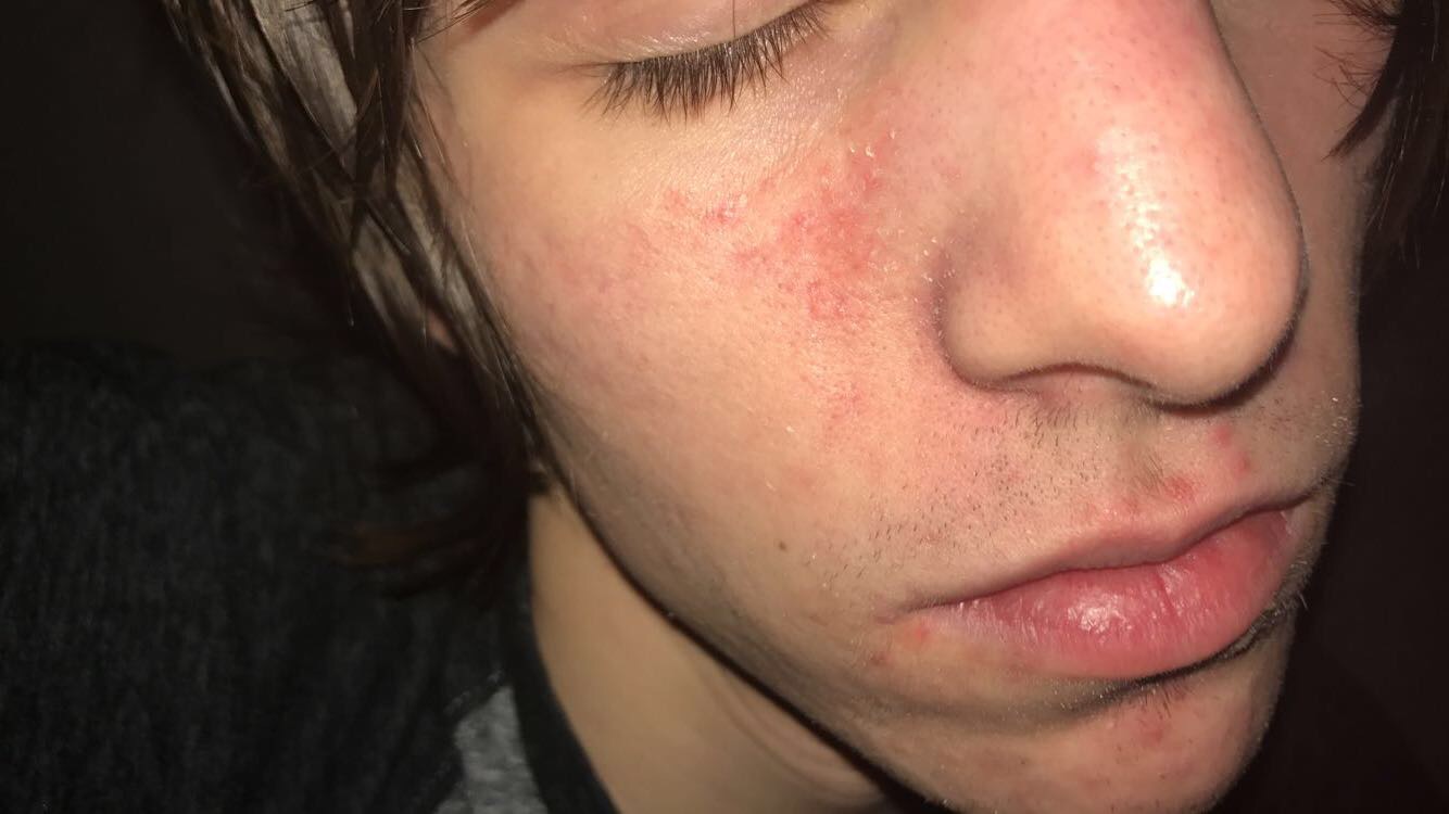 post-acne-marks-pics-general-acne-discussion-acne