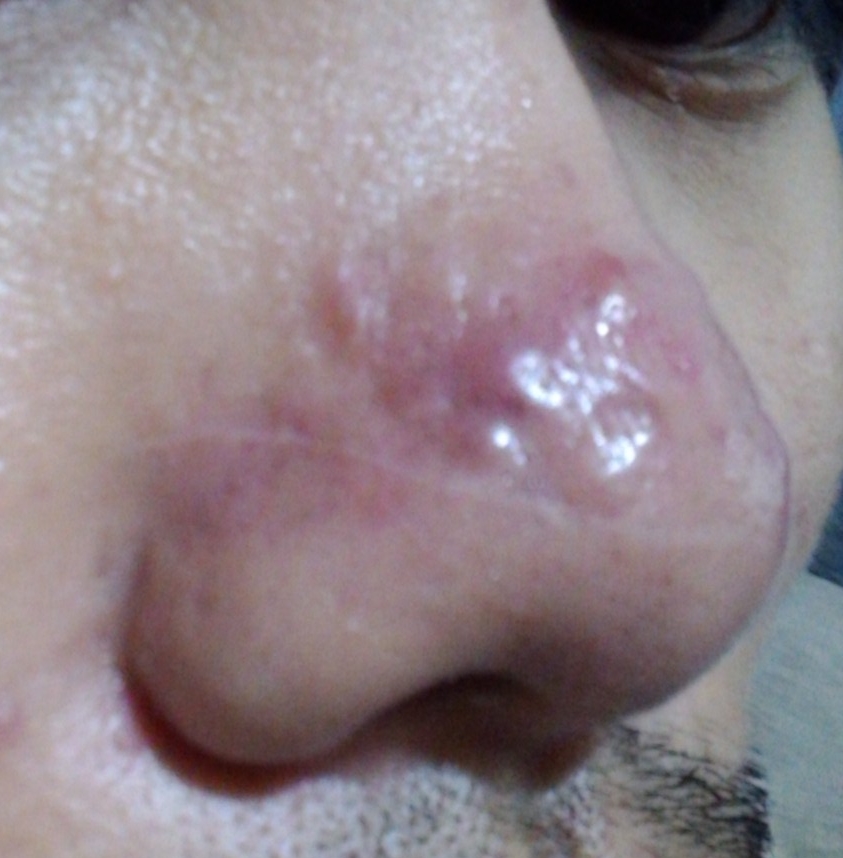Void Jairus's '(HELP) 5-YEAR OLD NOSE ACNE' - Pictures ...